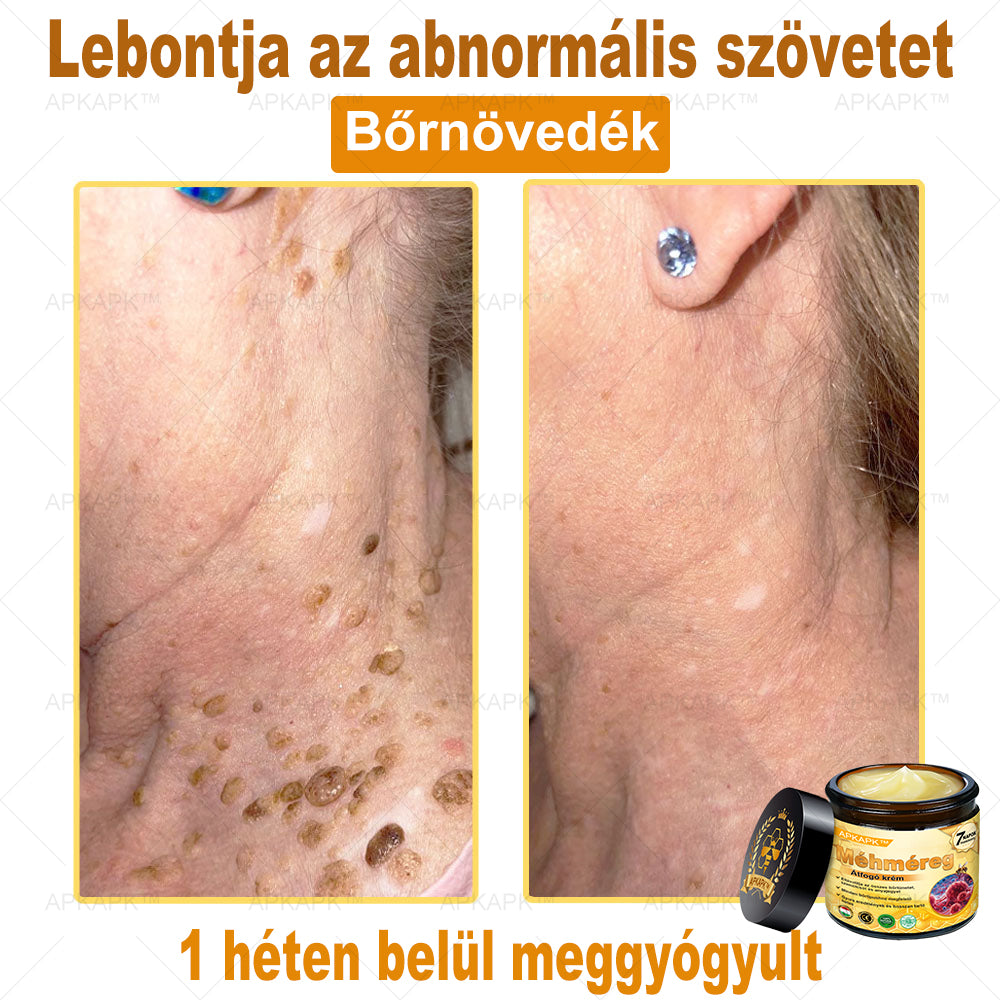 🐝🐝APKAPK® Méhméreg Átfogó Krém🔥 Magyar fejlesztés, magyarországi gyártás és szállítás