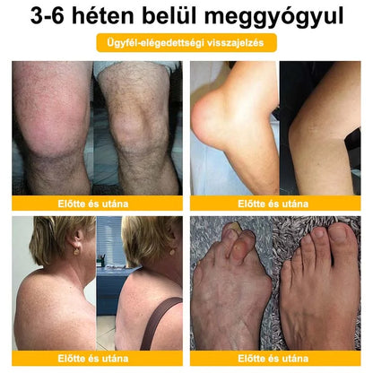 🐝🌿🐝 BEARNICA™ Bee Venom Advanced ízület- és csontkezelő krém🔥 (Utolsó napi akció, 80% kedvezmény)